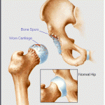 Degenerative Hip (Copyright MMG) Degenerative Hip (Copyright MMG)