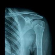 Shoulder Structure, Function and Common Problems