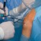 Knee Arthroscopy