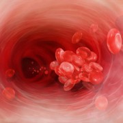 Thrombophlebitis