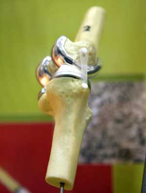 Knee model with prosthesis