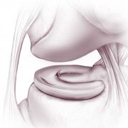 Meniscus Tears