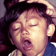 Whooping Cough (Pertussis)