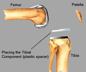 Placing tibial component - plastic spacer