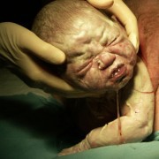 Episiotomy