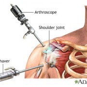 Shoulder Arthroscopy