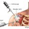 Shoulder Arthroscopy