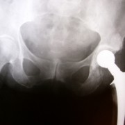Minimally Invasive Total Hip Replacement