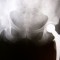 Minimally Invasive Total Hip Replacement