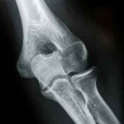 Medial Epicondylitis (Pitcher’s or Golfer’s Elbow)