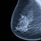 Breast Cancer: Stages and Treatment