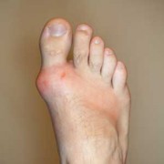 Gout