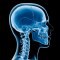 Craniotomy