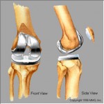 Knee Replacement Surgery | Prosthesis, Operation, Xray, Components